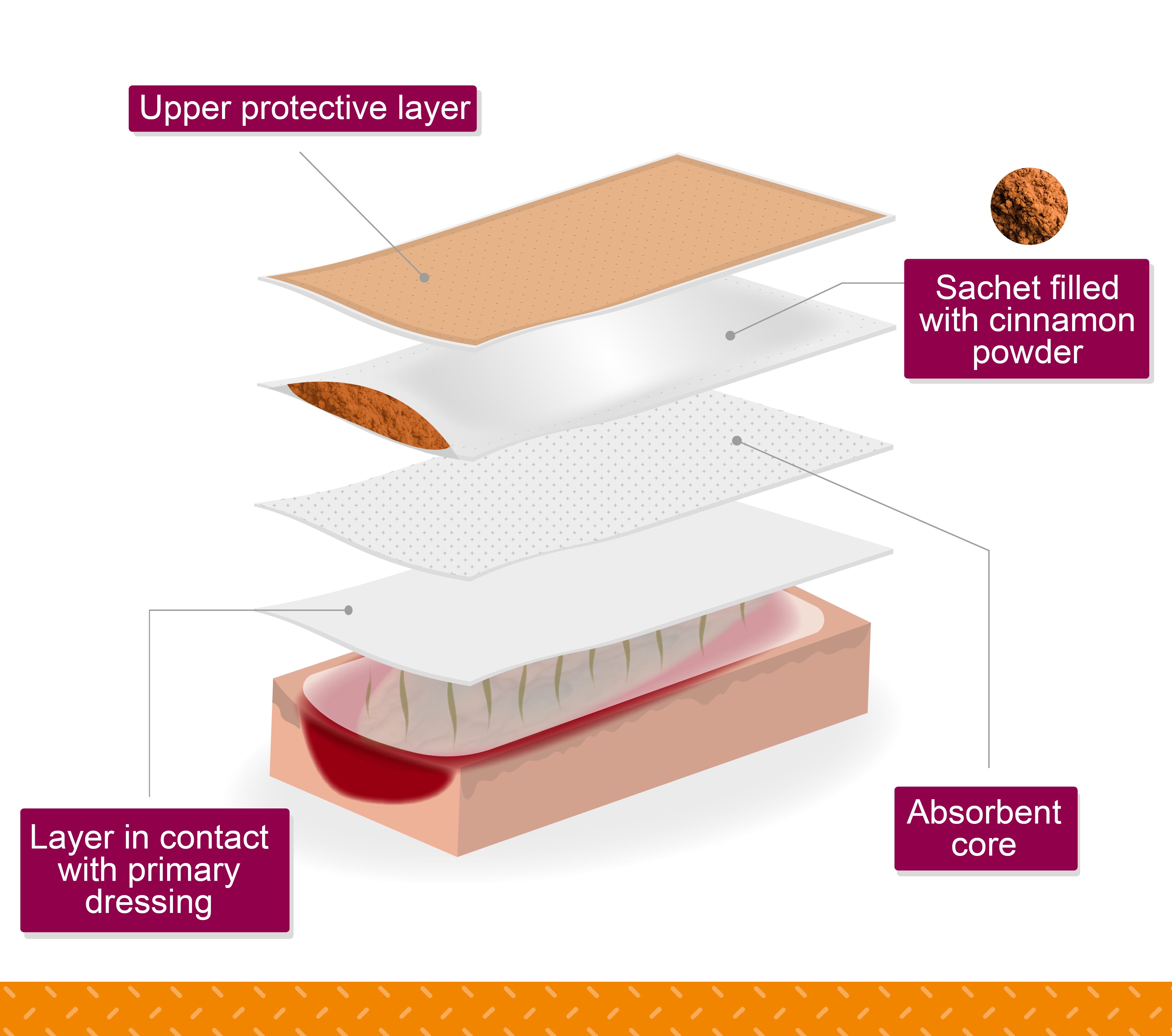 Cinesteam®, An effective secondary dressing for malodorous wounds